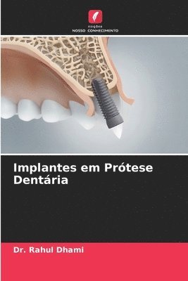 bokomslag Implantes em Prtese Dentria