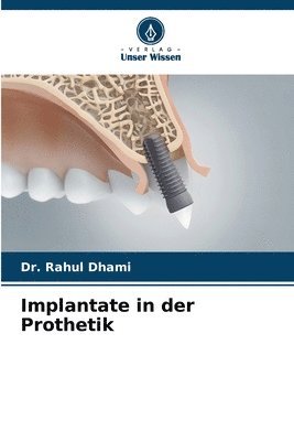 bokomslag Implantate in der Prothetik