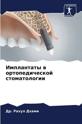 Имплантаты в ортопедической стоматологи&