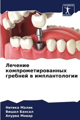 Нитика Малик, Вишал Бансал, Апурва Мовар, &#1 &#1052;&#1072;&#1083;&#1080;&#1082;, &#1041;&#1072;&#1085;&#1089;&#1072;&#108, ¿¿¿¿¿¿ ¿¿¿¿¿, ¿¿¿¿¿ ¿¿¿¿¿¿, Nitika Malik - Лечение компрометированных гребней в имп, Häftad