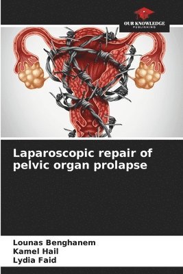 bokomslag Laparoscopic repair of pelvic organ prolapse