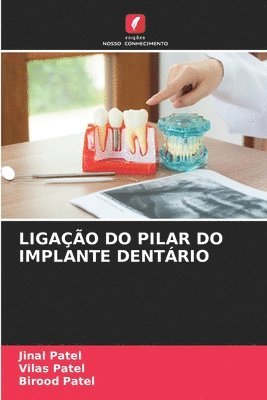 Ligao Do Pilar Do Implante Dentrio 1