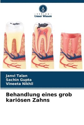 Behandlung eines grob karisen Zahns 1