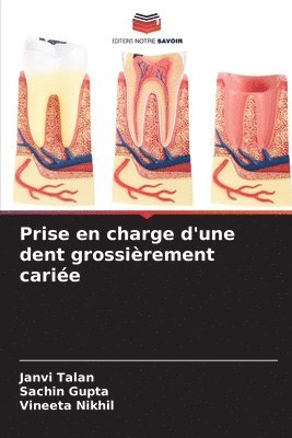 bokomslag Prise en charge d'une dent grossirement carie