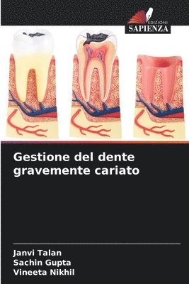 bokomslag Gestione del dente gravemente cariato