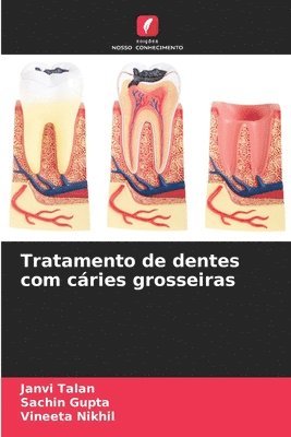 Tratamento de dentes com cries grosseiras 1