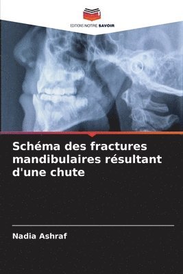 bokomslag Schma des fractures mandibulaires rsultant d'une chute