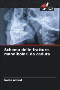 bokomslag Schema delle fratture mandibolari da caduta