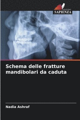 Schema delle fratture mandibolari da caduta 1