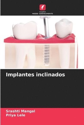 Srashti Mangal, Priya Lele - Implantes inclinados, Häftad