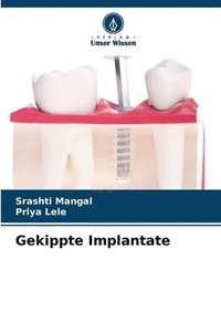 bokomslag Gekippte Implantate