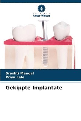 Srashti Mangal, Priya Lele - Gekippte Implantate, Häftad
