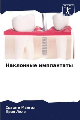 Срашти Мангал, Прия Леле - Наклонные имплантаты, Häftad