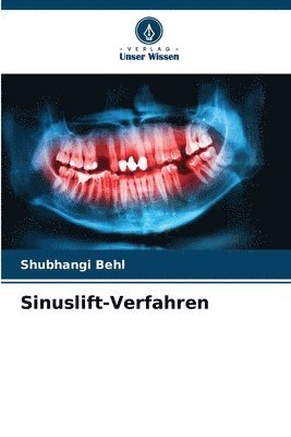 bokomslag Sinuslift-Verfahren