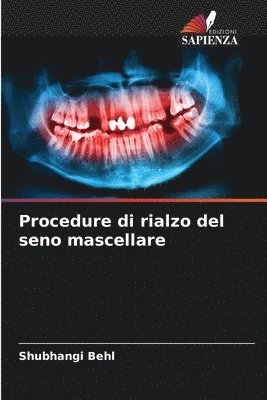 bokomslag Procedure di rialzo del seno mascellare