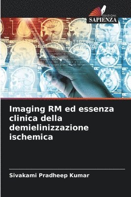 Sivakami Pradheep Kumar - Imaging RM ed essenza clinica della demielinizzazione ischemica, Häftad