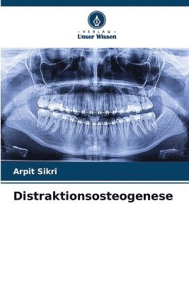 Arpit Sikri - Distraktionsosteogenese, Häftad