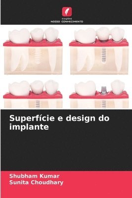 bokomslag Superfcie e design do implante