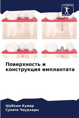 Шубхам Кумар, Сунита Чоудхары, &#1 &#1050;&#1091;&#1084;&#1072;&#1088;, &#1063;&#1086;&#1091;&#1076;&#1093;&#107, ¿¿¿¿¿¿ ¿¿¿¿¿, ¿¿¿¿¿¿ ¿¿¿¿¿¿¿¿ - Поверхность и конструкция имплантата, Häftad
