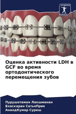Оценка активности Ldh в Gcf во время ортодонтич&#107
