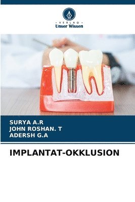 bokomslag Implantat-Okklusion