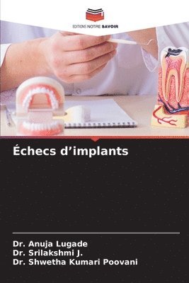 Anuja Lugade, Srilakshmi J, Shwetha Kumari Poovani, Dr. Anuja Lugade, Dr. Srilakshmi J., Srilakshmi J. - Échecs d'implants, Häftad