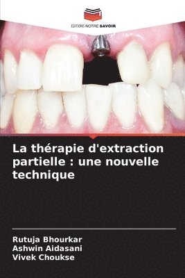 La thrapie d'extraction partielle 1