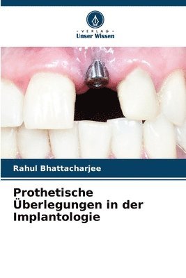 Prothetische berlegungen in der Implantologie 1