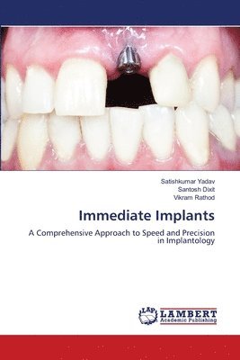 Satishkumar Yadav, Santosh Dixit, Vikram Rathod - Immediate Implants, Häftad