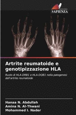 Artrite reumatoide e genotipizzazione HLA 1