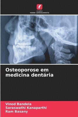 Osteoporose em medicina dentria 1