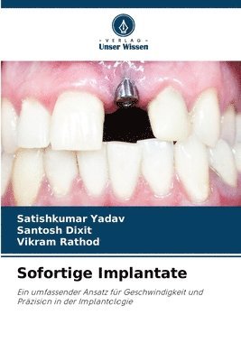 Sofortige Implantate 1