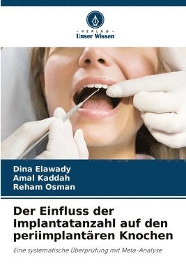 Einfluss der Implantatanzahl auf den periimplantären Knochen