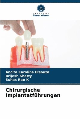 Ancita Caroline D'Souza, Brijesh Shetty, Suhas Rao K, Ancita Caroline D'souza - Chirurgische Implantatführungen, Häftad