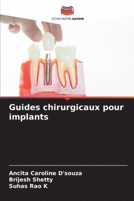 Guides chirurgicaux pour implants 1