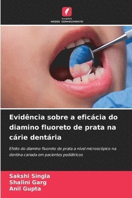 Evidência sobre a eficácia do diamino fluoreto de prata na cárie dentária
