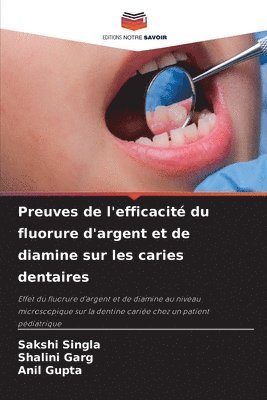 Preuves de l'efficacité du fluorure d'argent et de diamine sur les caries dentaires