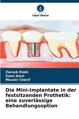 Zeineb Riahi, Sami Amri, Mounir Cherif - Mini-Implantate in der festsitzenden Prothetik, Häftad