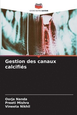 Gestion des canaux calcifis 1