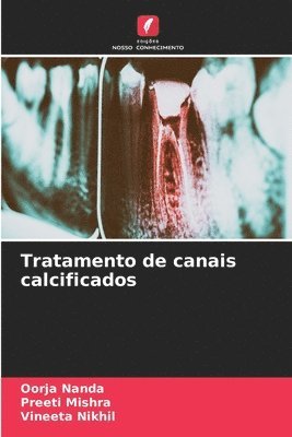Oorja Nanda, Preeti Mishra, Vineeta Nikhil - Tratamento de canais calcificados, Häftad