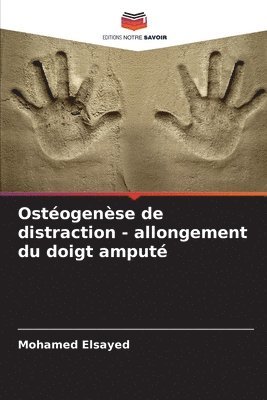 Ostéogenèse de distraction - allongement du doigt amputé 1