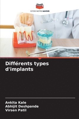 bokomslag Diffrents types d'implants