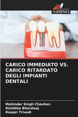 Carico Immediato vs. Carico Ritardato Degli Impianti Dentali