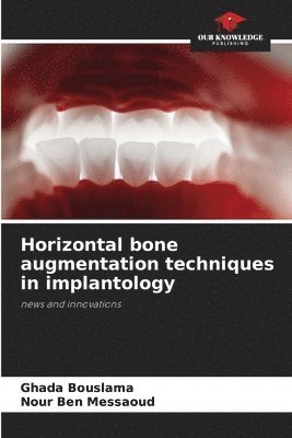 bokomslag Horizontal bone augmentation techniques in implantology