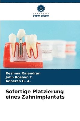 Reshma Rajendran, John Roshan, Adhersh G a, John Roshan  T., John Roshan T., Adhersh G. A. - Sofortige Platzierung eines Zahnimplantats, Häftad