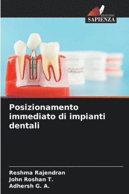 bokomslag Posizionamento immediato di impianti dentali