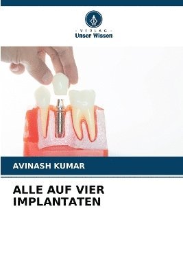 bokomslag Alle Auf Vier Implantaten