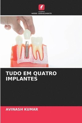 bokomslag Tudo Em Quatro Implantes