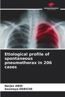 bokomslag Etiological profile of spontaneous pneumothorax in 206 cases