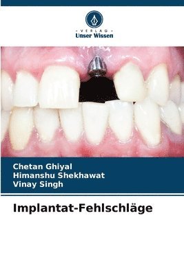 bokomslag Implantat-Fehlschläge